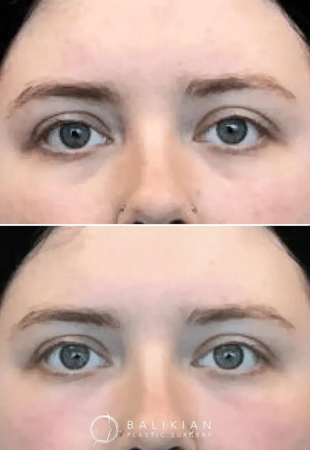 Filler treatment for mild under-eye hollowing. Results show brighter eyes and smoother skin texture.