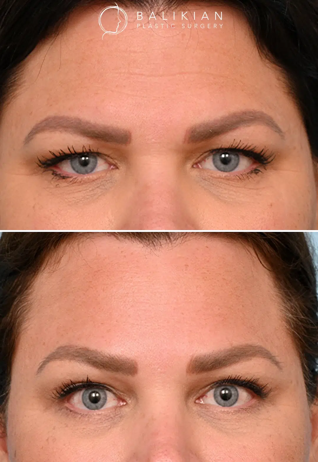 Before and after photos of a woman’s forehead lift, frontal view, showing smoother forehead lines and elevated brows for a refreshed expression.