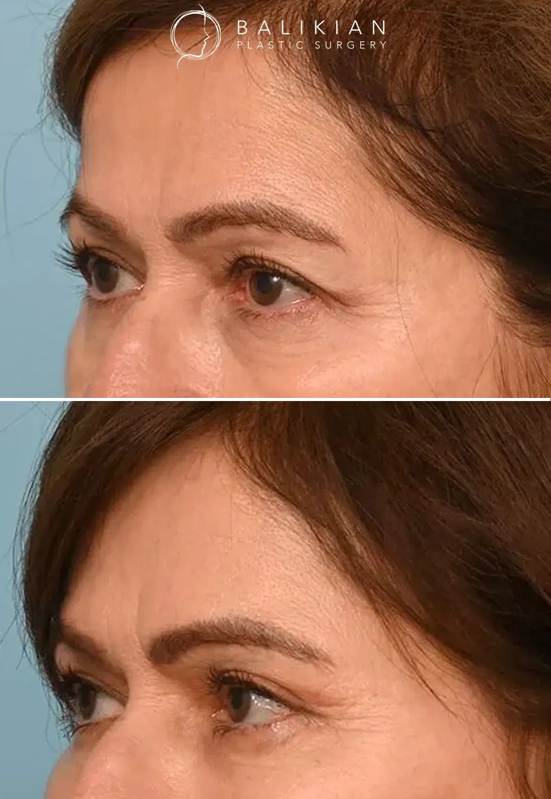 Dr. Balikian’s goal is always to enhance each patient’s natural beauty with results that look authentic and last. For this patient in her 60s seeking a refreshed appearance, he achieved exactly that. Before and after oblique view of a woman after brow lift procedure, highlighting elevated brows and smoother skin around the upper eyelids.