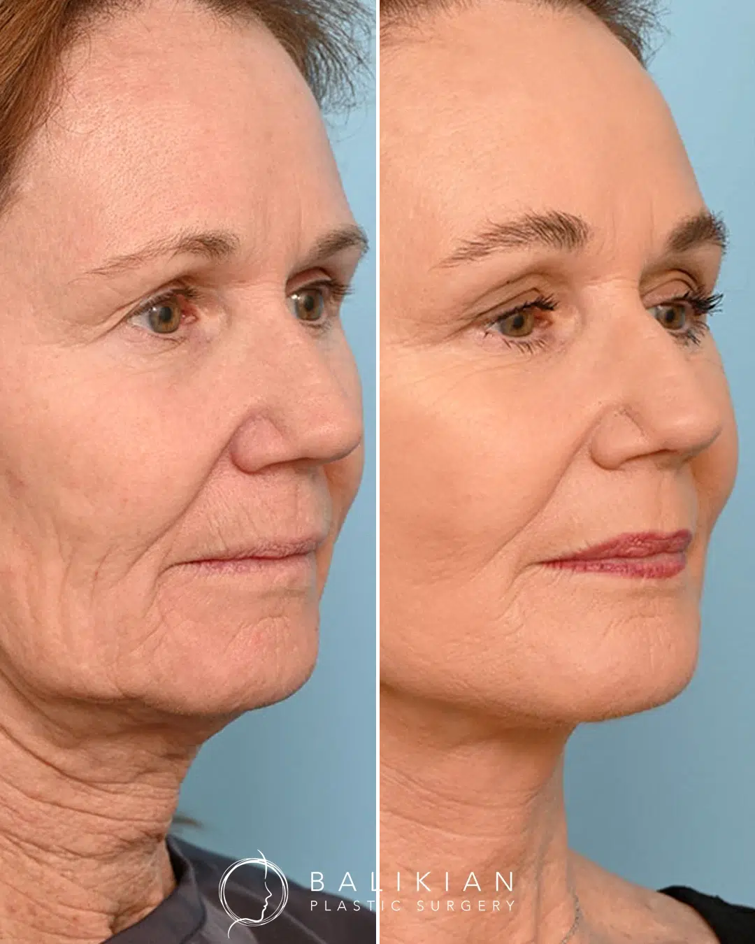 Fractional CO2 laser skin resurfacing before and after photos showing smoother complexion, softened wrinkles, and natural skin renewal.