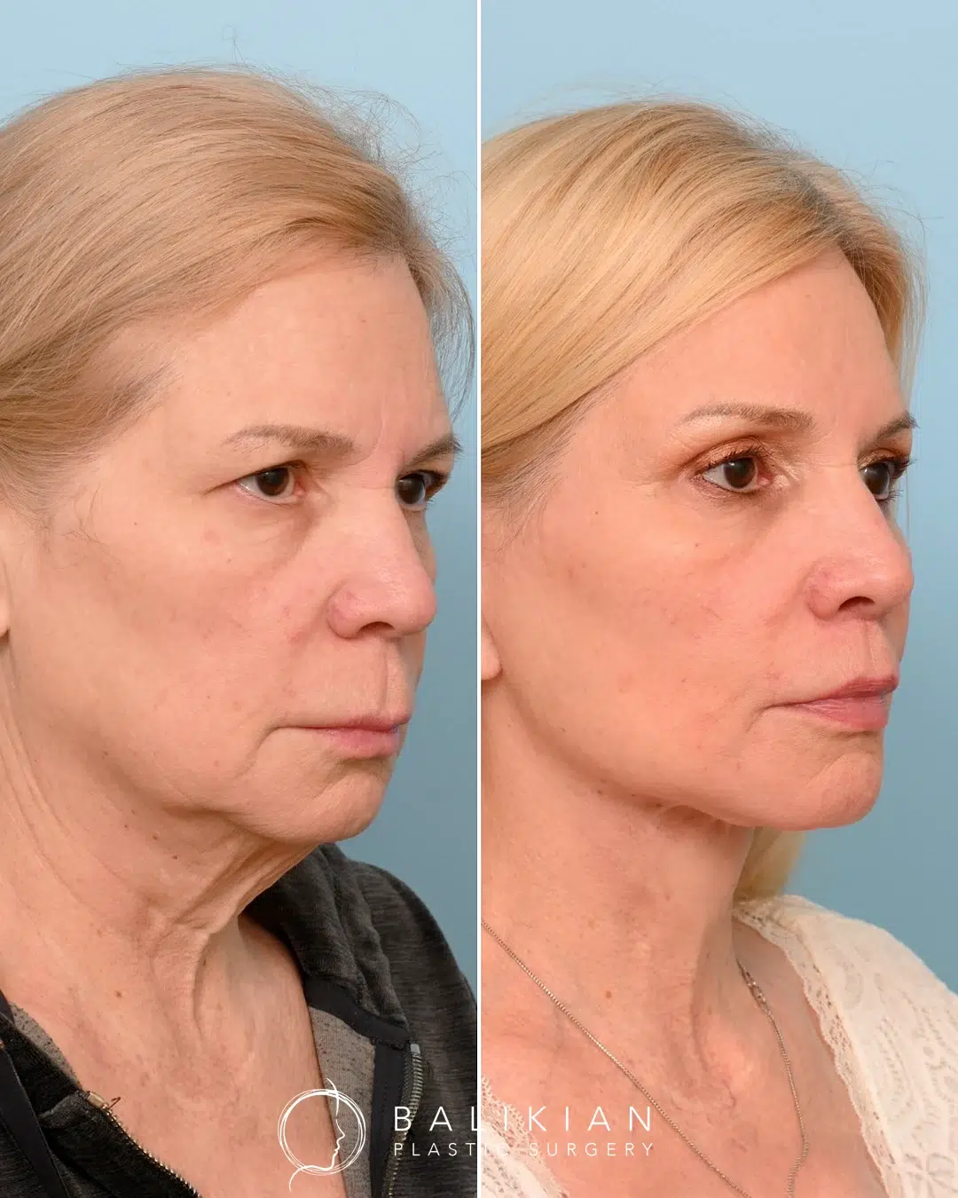CO2 laser skin resurfacing before and after showing improved skin smoothness, reduced facial wrinkles, and overall rejuvenation.