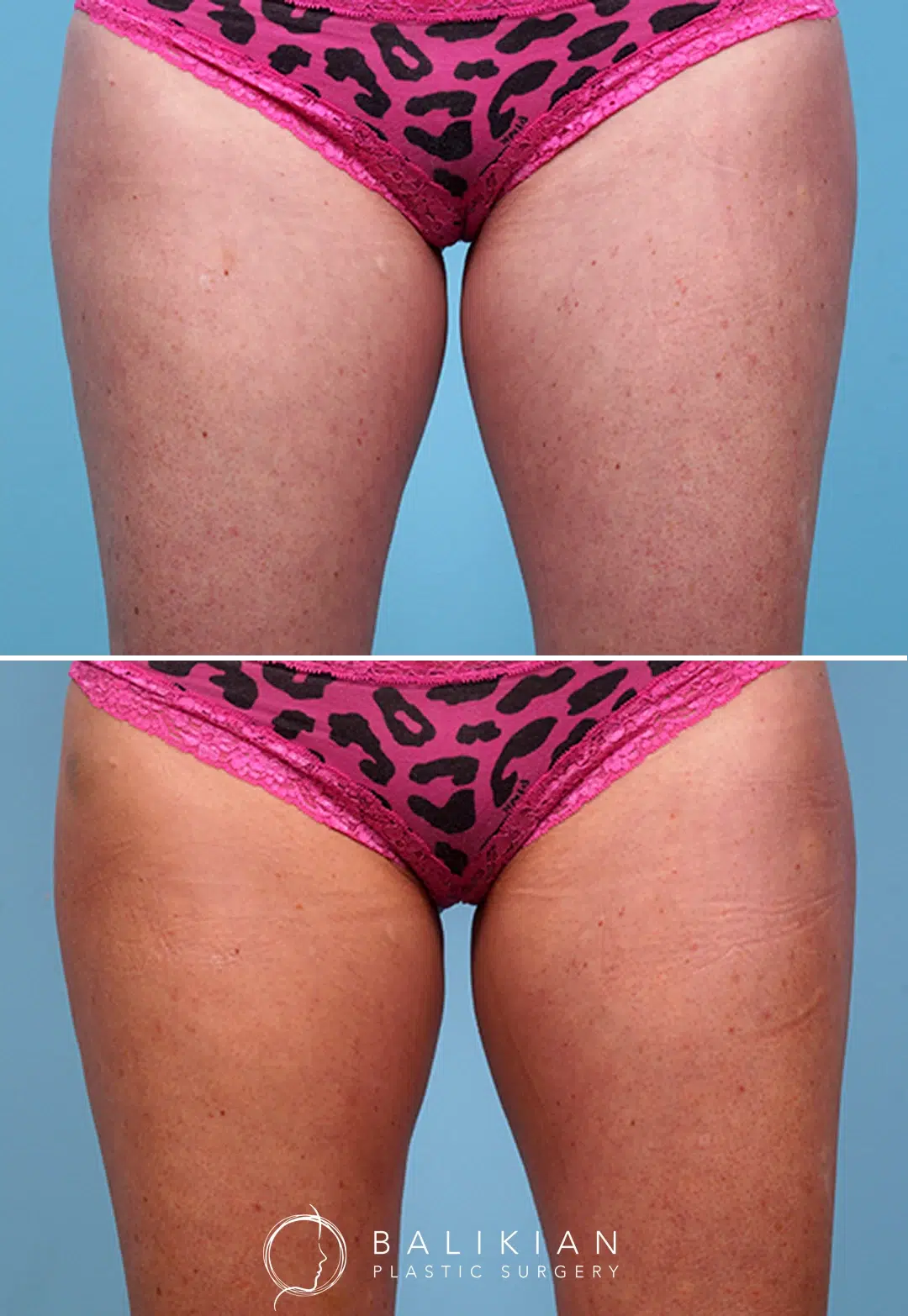 Before and after photo of a woman’s inner thighs following CoolSculpting treatment. The after image shows a visible reduction in inner thigh fat and improved leg contour.