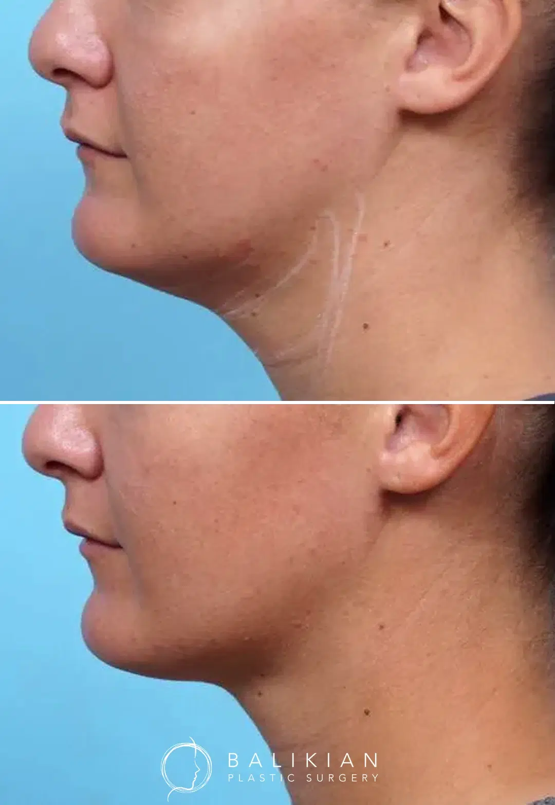 Female patient shown before and after Kybella, with visible fat reduction under the chin and improved neckline.