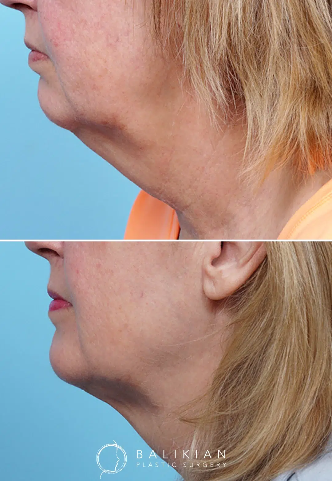 Mature female patient before and after Kybella showing reduced fullness beneath the chin and a more defined neck profile.