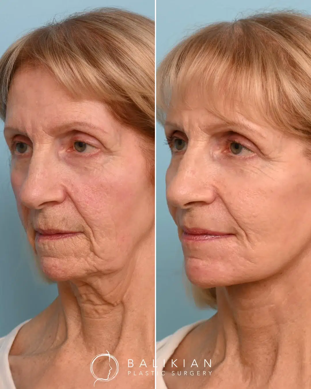 Temecula Valley CO2 laser resurfacing before and after photo showing tighter, smoother skin with noticeable wrinkle reduction.