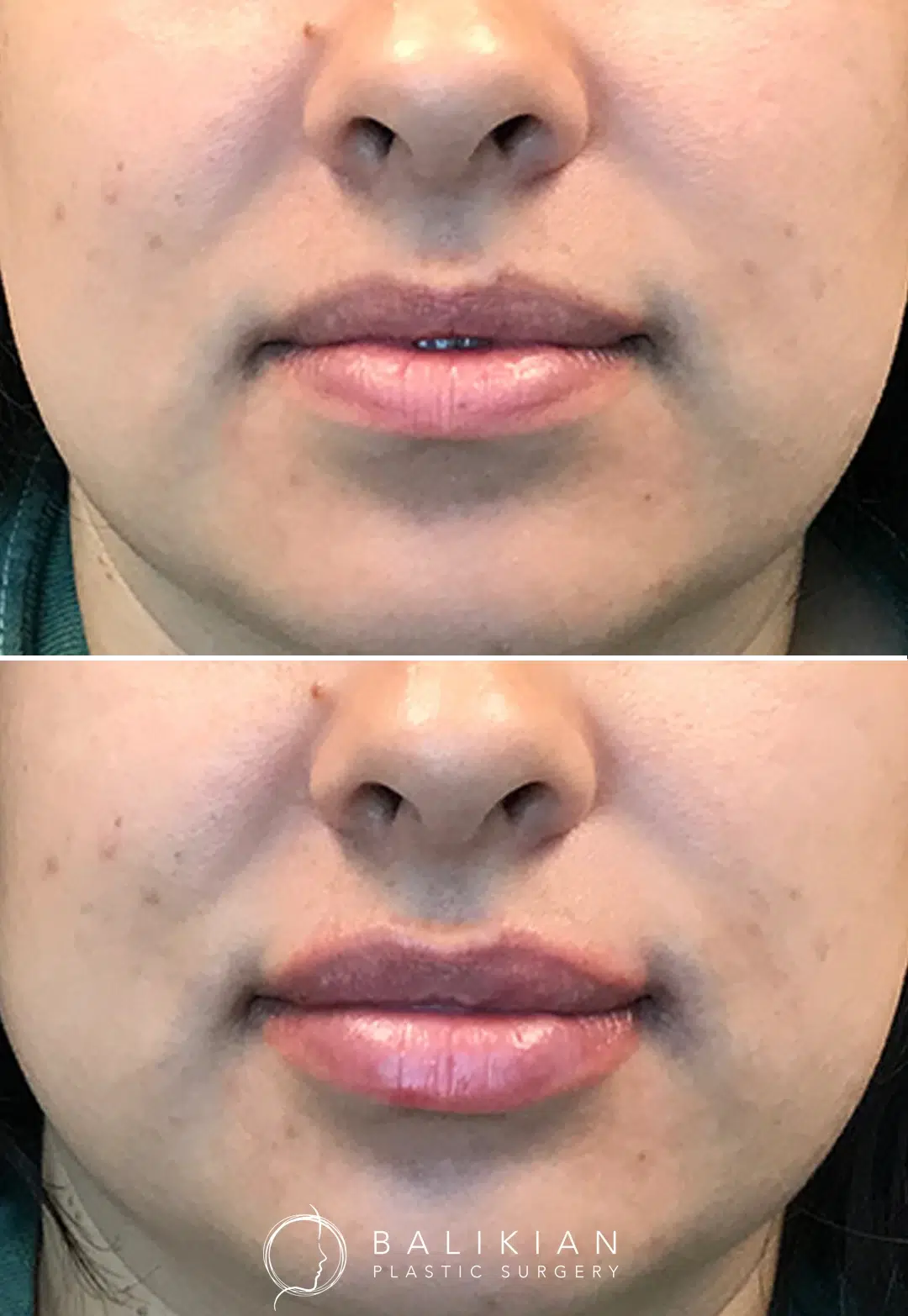 Patient’s lips shown before and after non-surgical lip augmentation with noticeable improvement in volume and shape