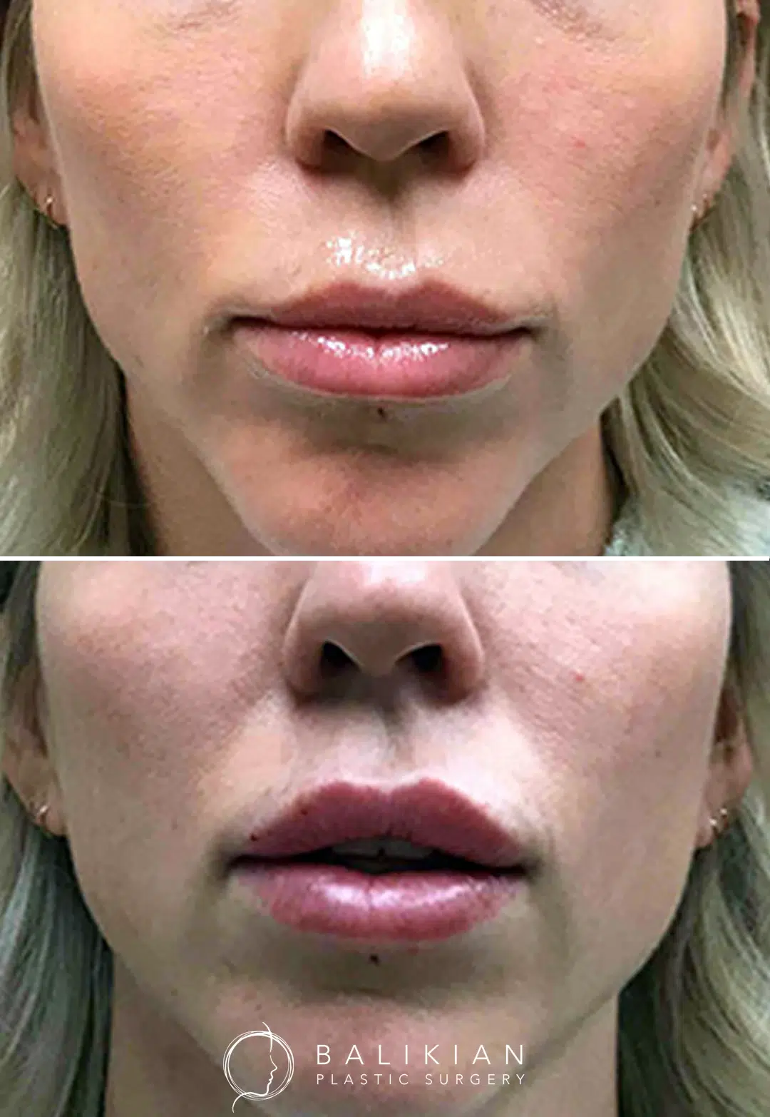 Side-by-side image of lips before and after lip filler injections showing increased volume and contour