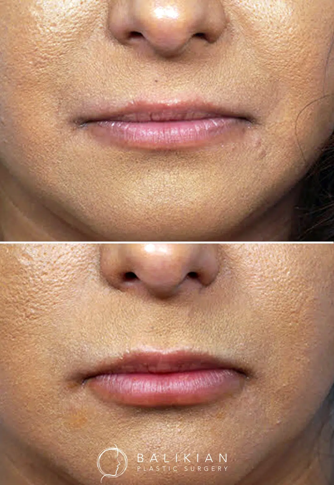 Side-by-side before and after photos of a female patient showing fuller, more defined lips following lip filler treatment