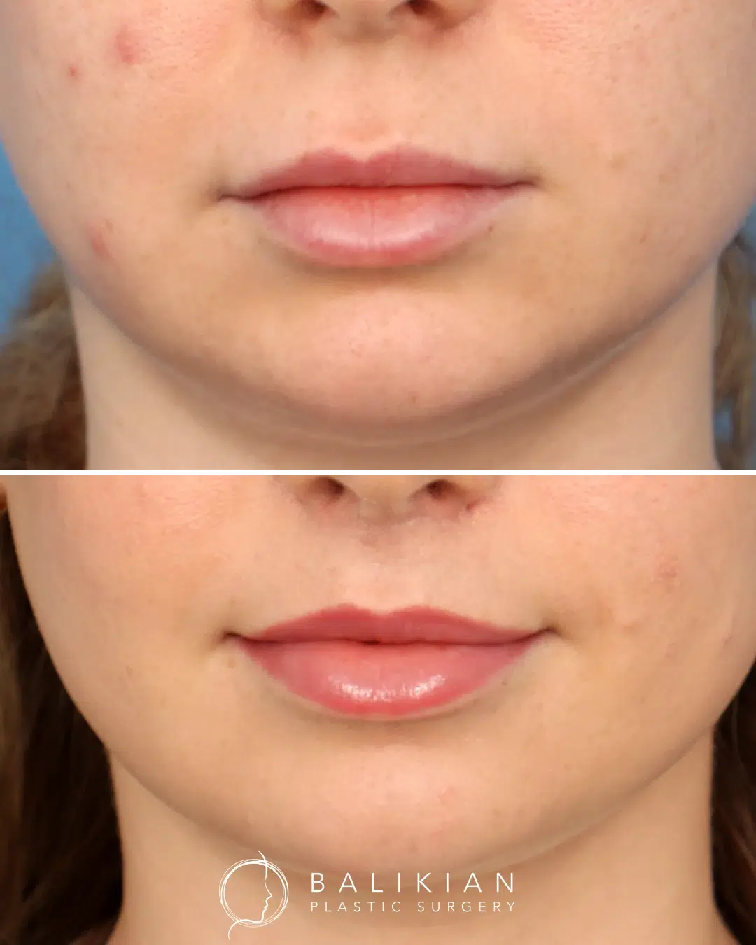 Lip lift before and after front view showing a more defined cupid’s bow, fuller upper lip, and improved facial balance.