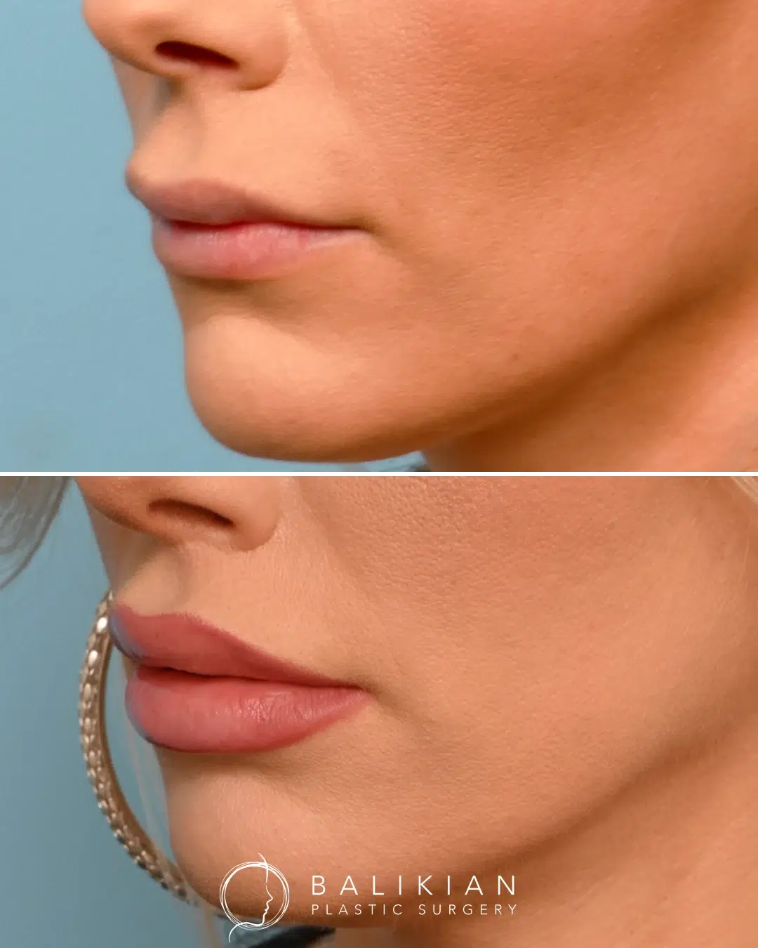 Lip lift before and after angled view showing natural-looking enhancement of upper lip shape and improved smile symmetry.