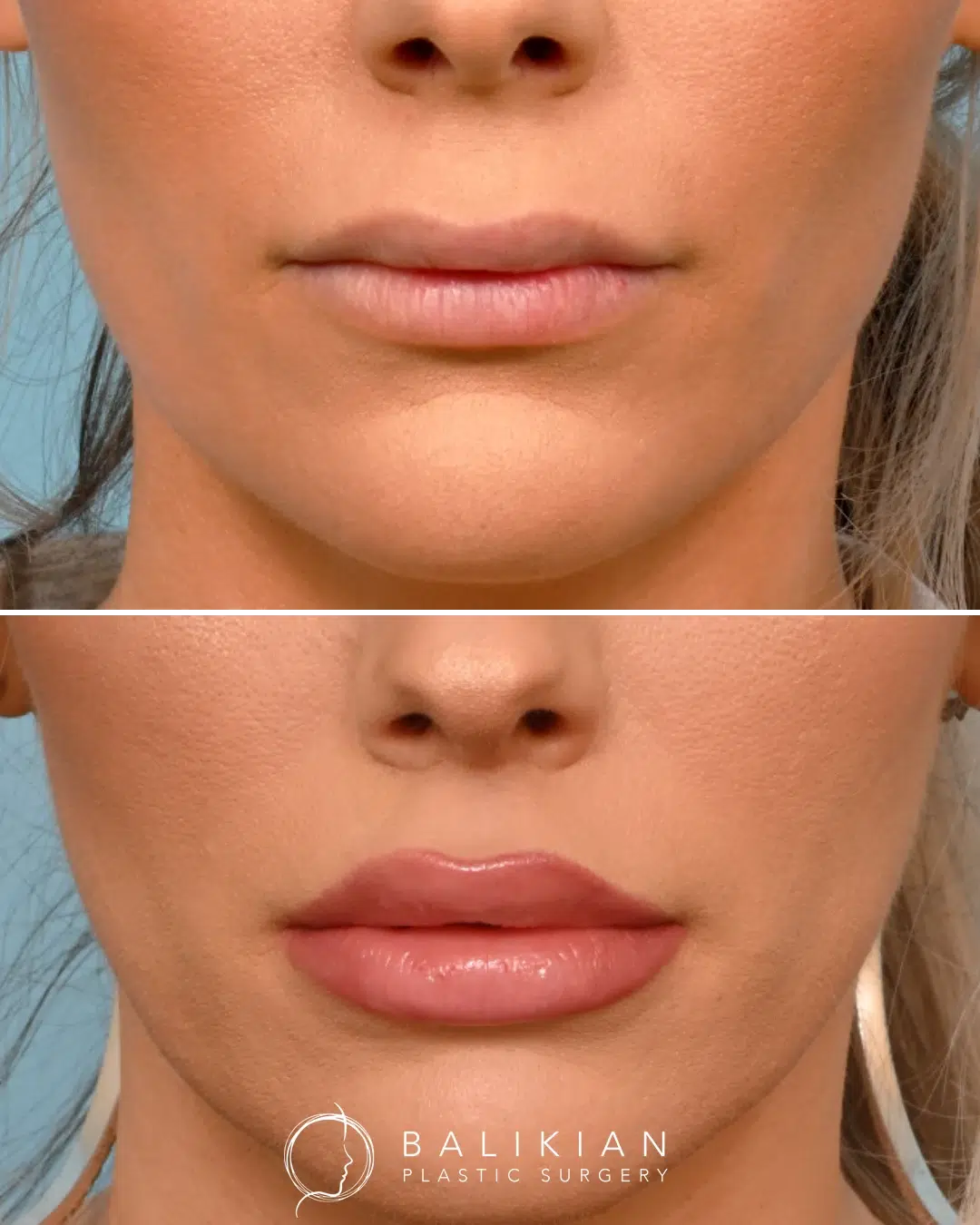 Upper lip lift before and after close-up showing subtle, natural improvement in upper lip definition and fullness.