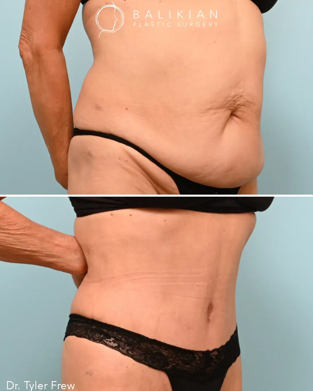 Liposuction Before & After Patient Transformations