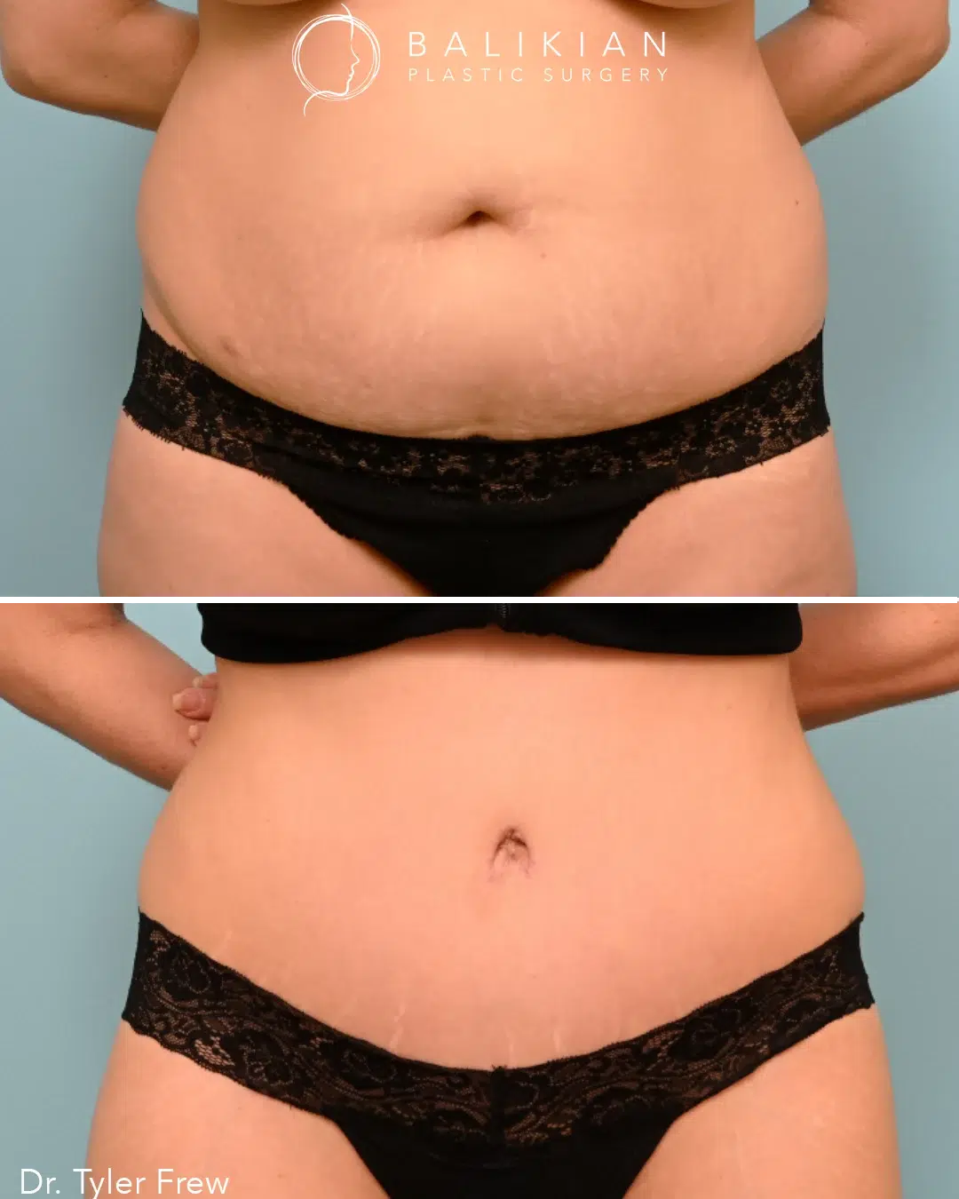 Female abdomen liposuction and tummy tuck before and after, side view. Before: protruding abdomen with stretch marks. After: smooth, toned abdominal profile.