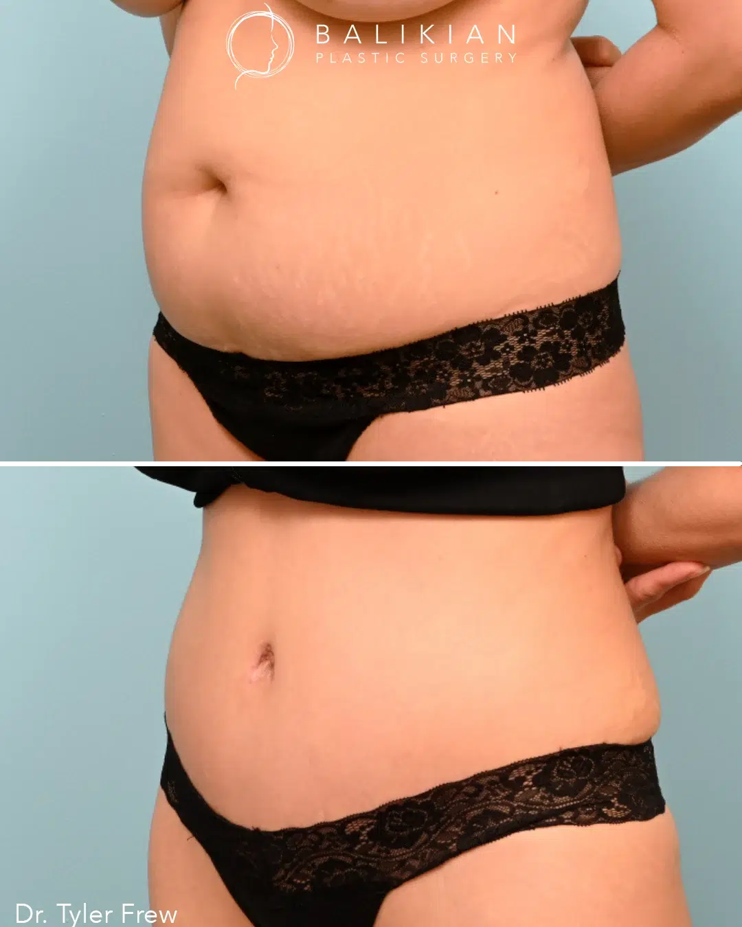 Female abdomen liposuction and tummy tuck before and after, side view. Before: protruding abdomen with stretch marks. After: smooth, toned abdominal profile.