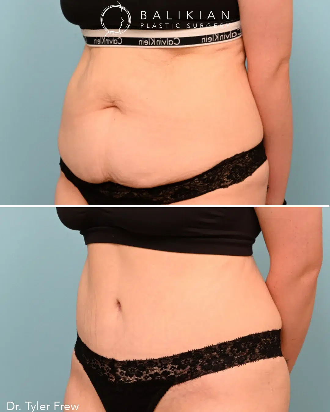 Female abdomen liposuction and tummy tuck before and after, oblique view. Before: excess fat and skin laxity along abdomen and waist. After: defined waistline and flat stomach.