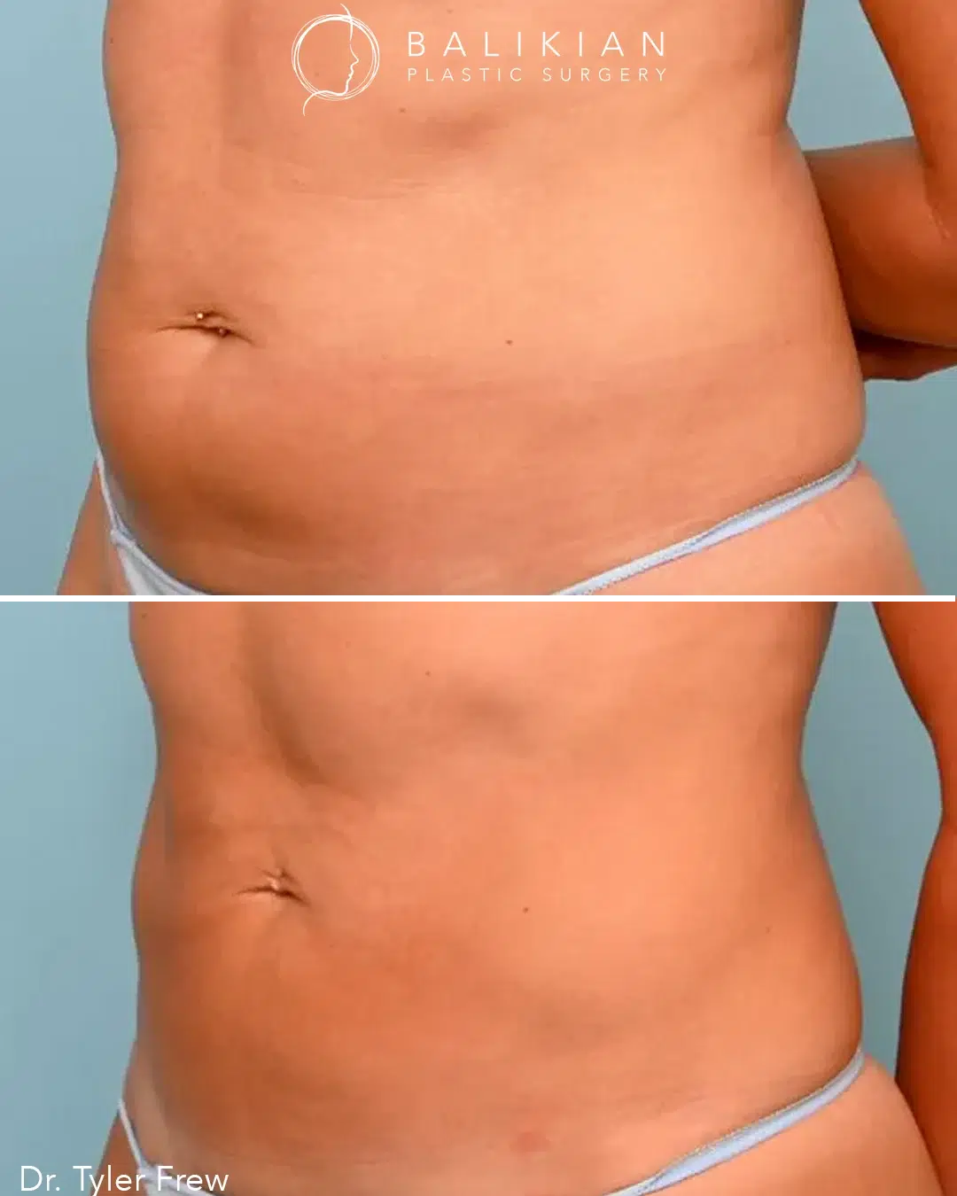 Female abdomen liposuction with abdominoplasty before and after, oblique view. Before: excess fat and skin laxity around the midsection. After: firmer, more defined waistline and toned stomach.