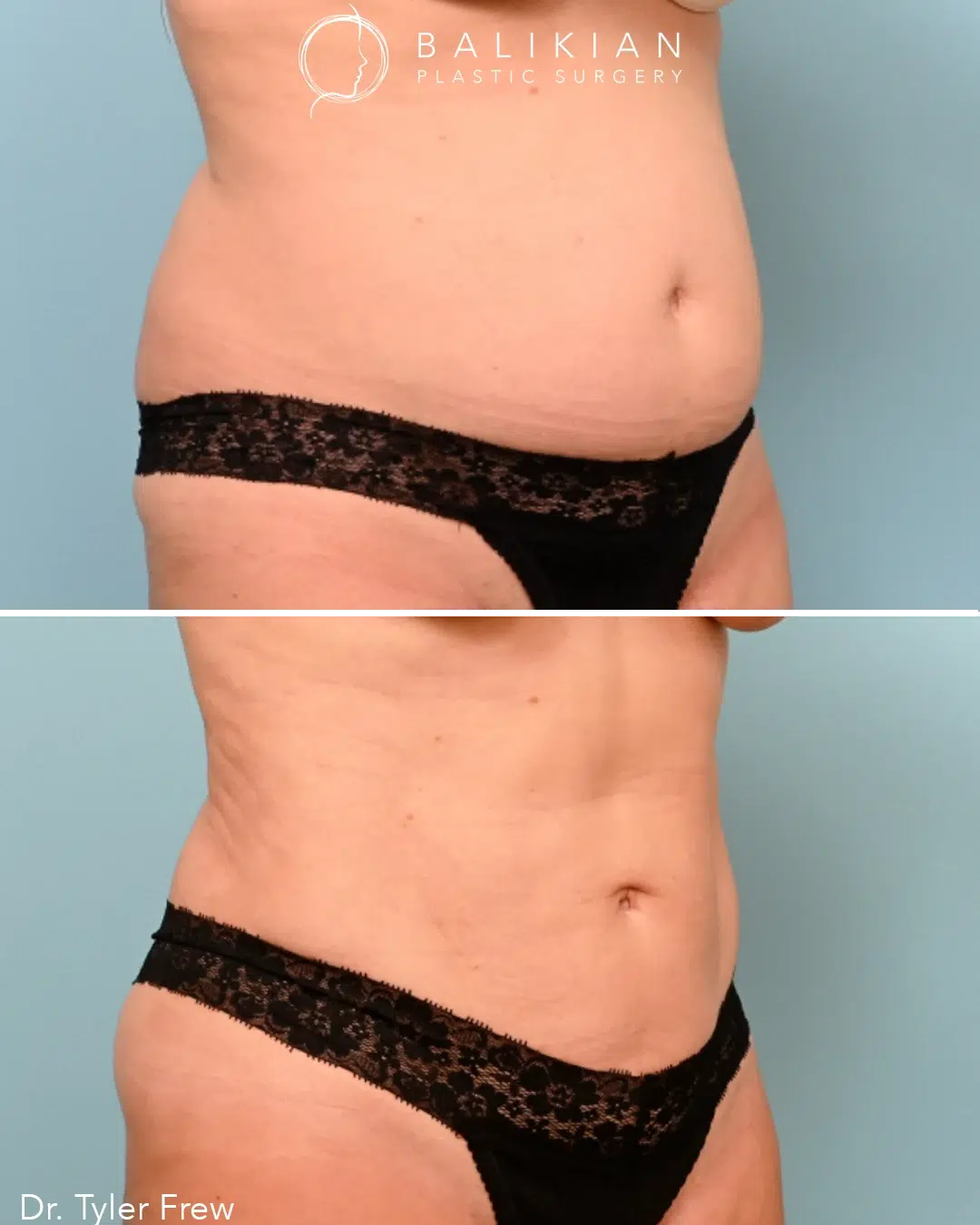 lipo or tummy tuck after c section Tummy Tuck vs. Liposuction: Which Procedure Is Right for You?