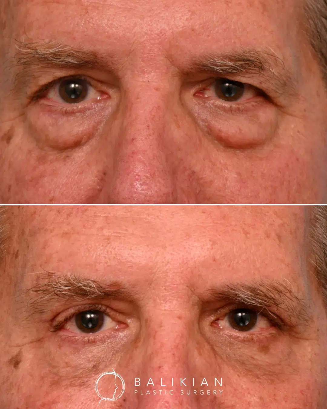 Lower blepharoplasty results reducing under-eye bags for a smoother, rested look.
