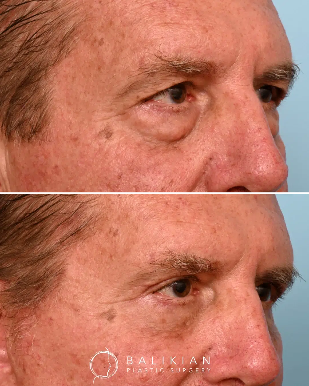 Before and after lower eyelid surgery with improved under-eye contour and reduced puffiness.