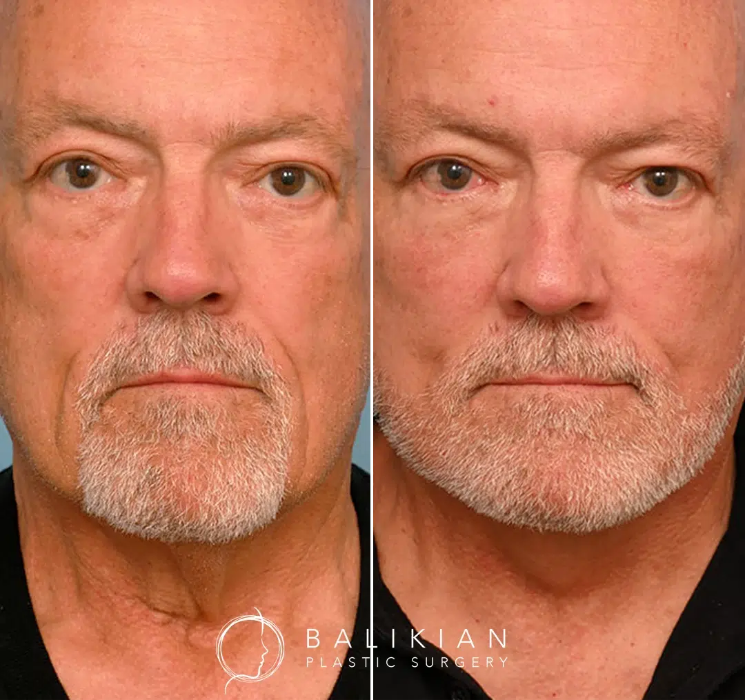 Front-facing before-and-after photos of an older man after facelift surgery, showing firmer skin, improved jawline contour, and a more youthful expression.