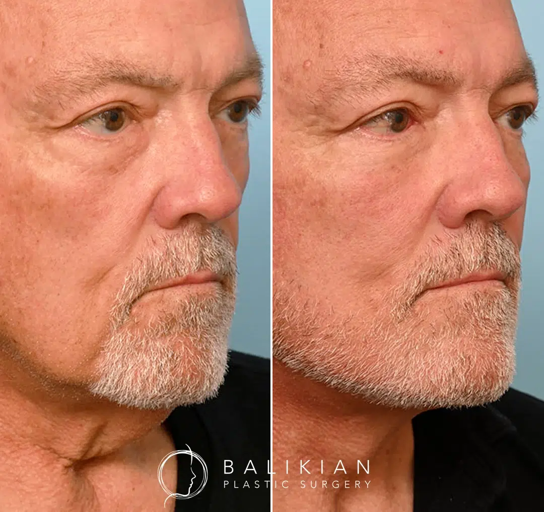 Angled before-and-after photos of an older man following facelift surgery, with reduced laxity in the jawline and neck and a more sculpted profile.