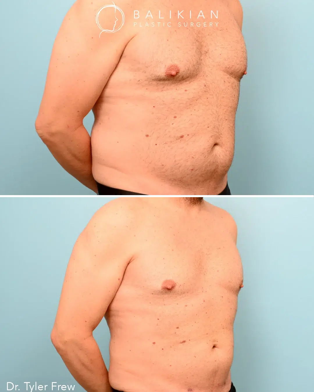 Male abdominal liposuction before and after, oblique view. Before: abdominal protrusion and fullness at the waist. After: smoother, more toned midsection.
