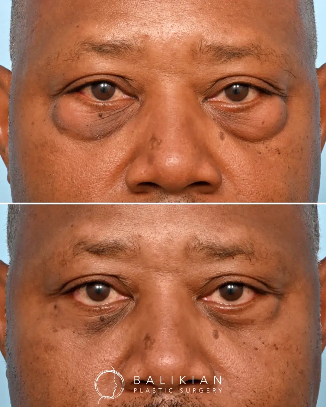 Male lower blepharoplasty showing natural reduction of under-eye bags for a refreshed appearance.