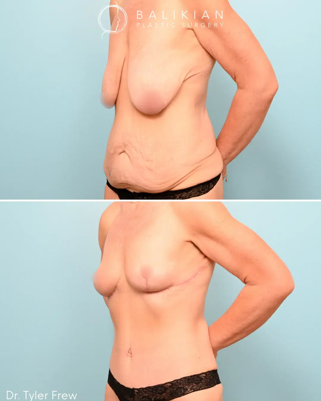 Angled side view of a female patient before and after Mommy Makeover, highlighting lifted breasts, reduced skin laxity, and a smoother abdominal profile.