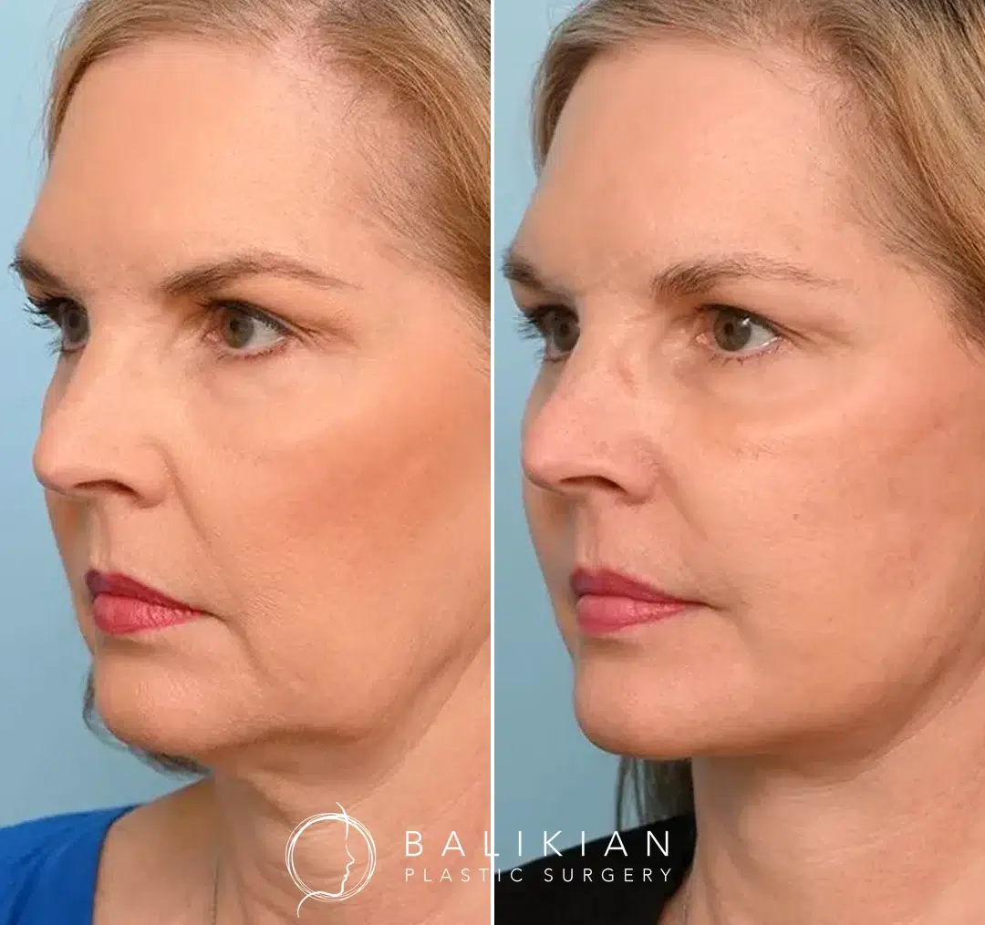 Side view before and after facelift and neck lift, showing firm neck and natural contour.