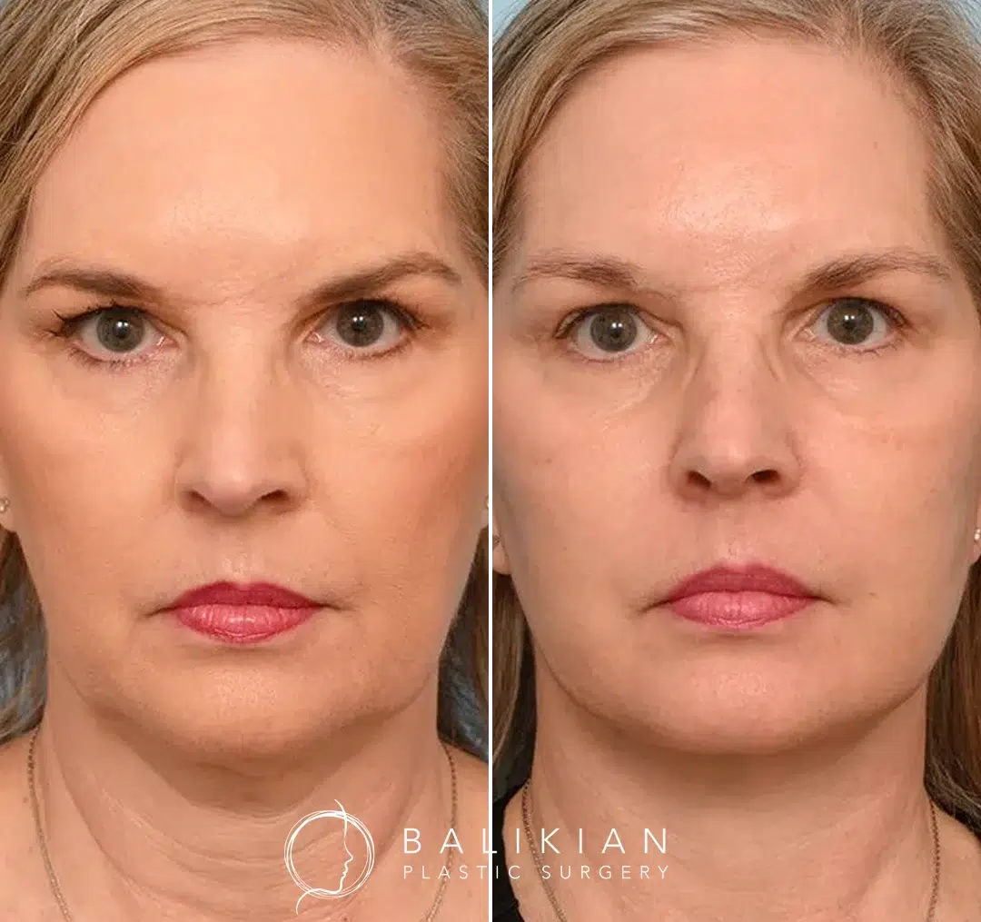 Frontal view before and after facelift and neck lift, showing smoother jawline and refreshed face.