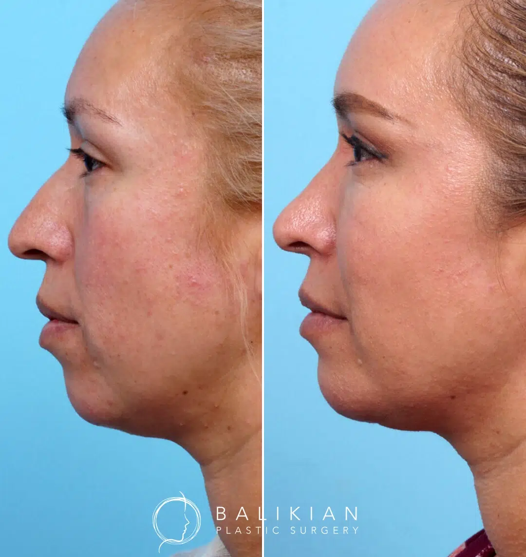 Profile view highlighting a sharper jawline and smoother transition from chin to neck.