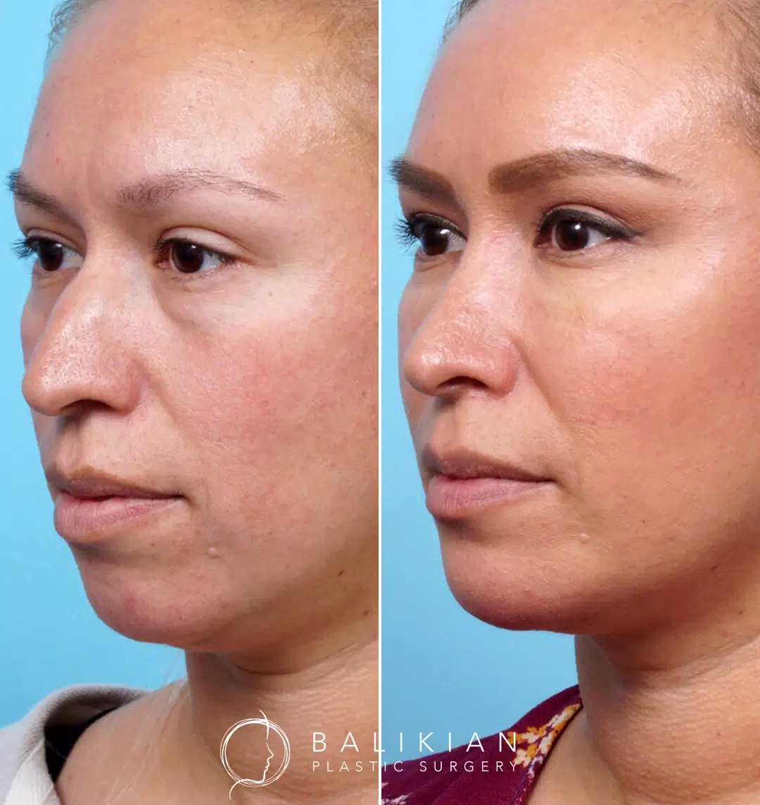 Angled view showing a slimmer neck and enhanced jawline following treatment.