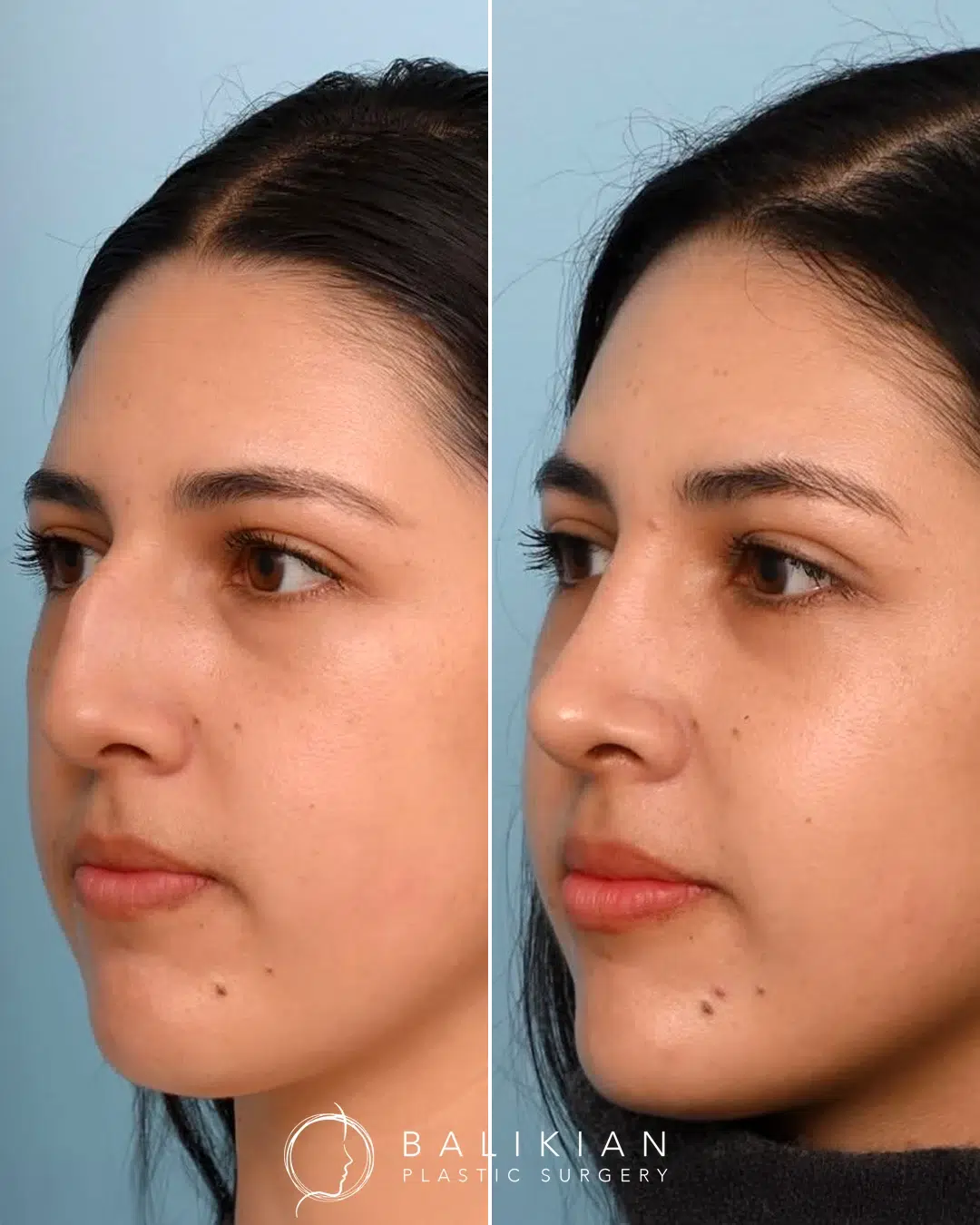 Rhinoplasty before and after, female left oblique view. Hump reduction and gentle tip refinement. Left is before, right is after.