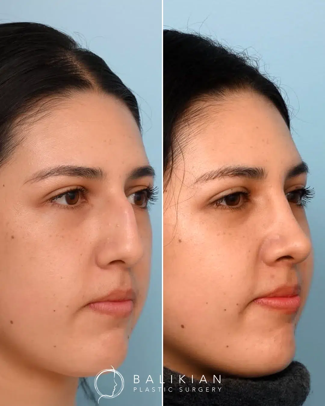 Rhinoplasty before and after, female right oblique view. Smoother bridge and softened tip for a balanced profile. Left is before, right is after.