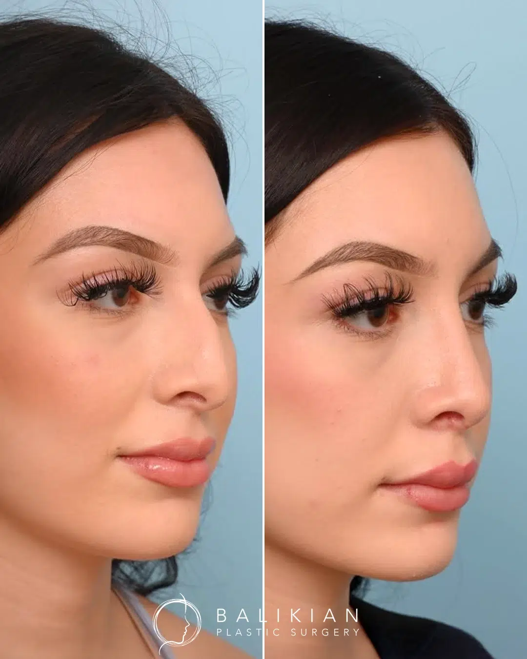 Before and after rhinoplasty, oblique view, bridge smoothed and tip refined for a softer balanced profile.