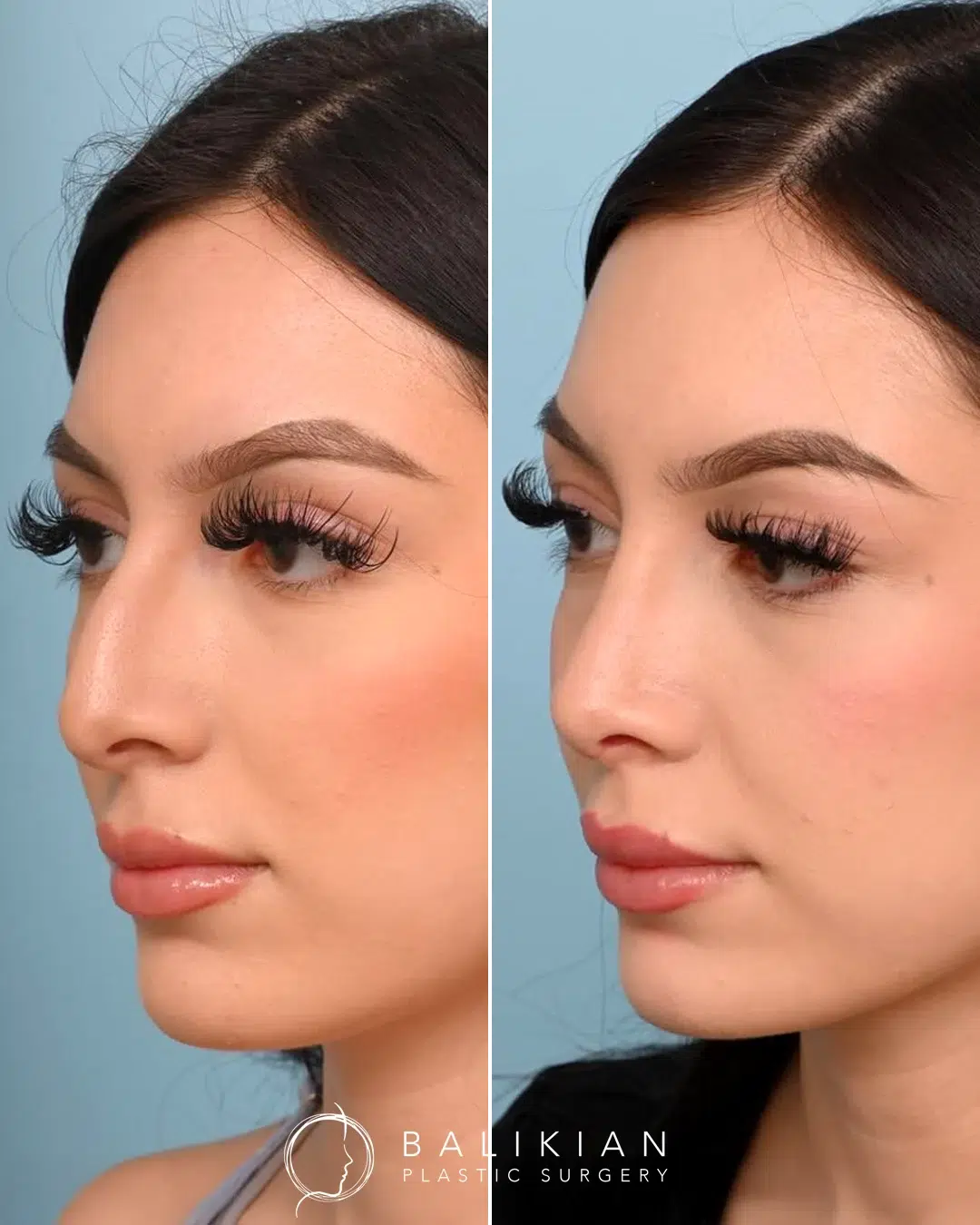 Before and after rhinoplasty, oblique view, dorsum straightened and tip softened for a natural result.