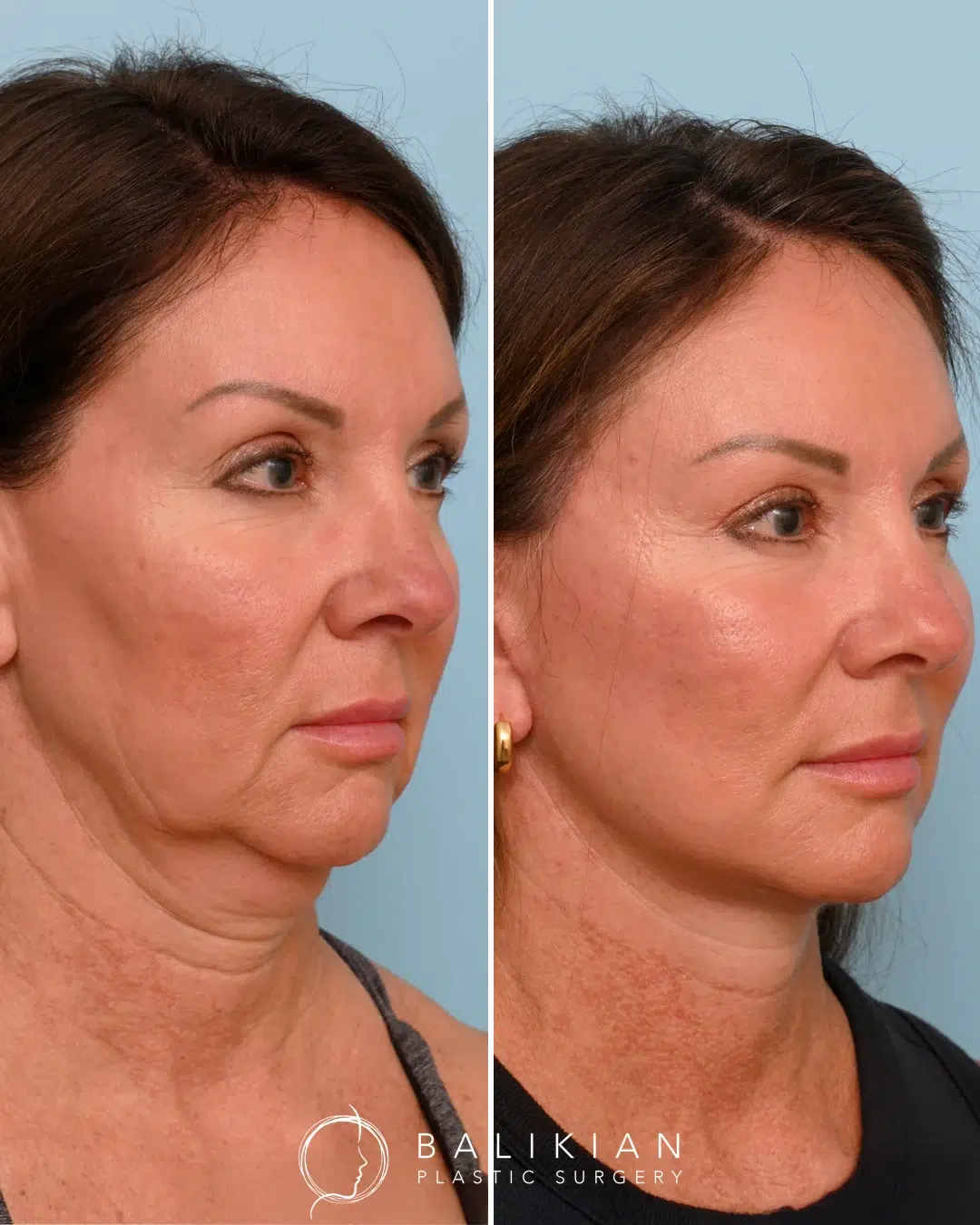 Profile view before and after deep plane facelift in Orange County showing sharper jawline and smoother neck.