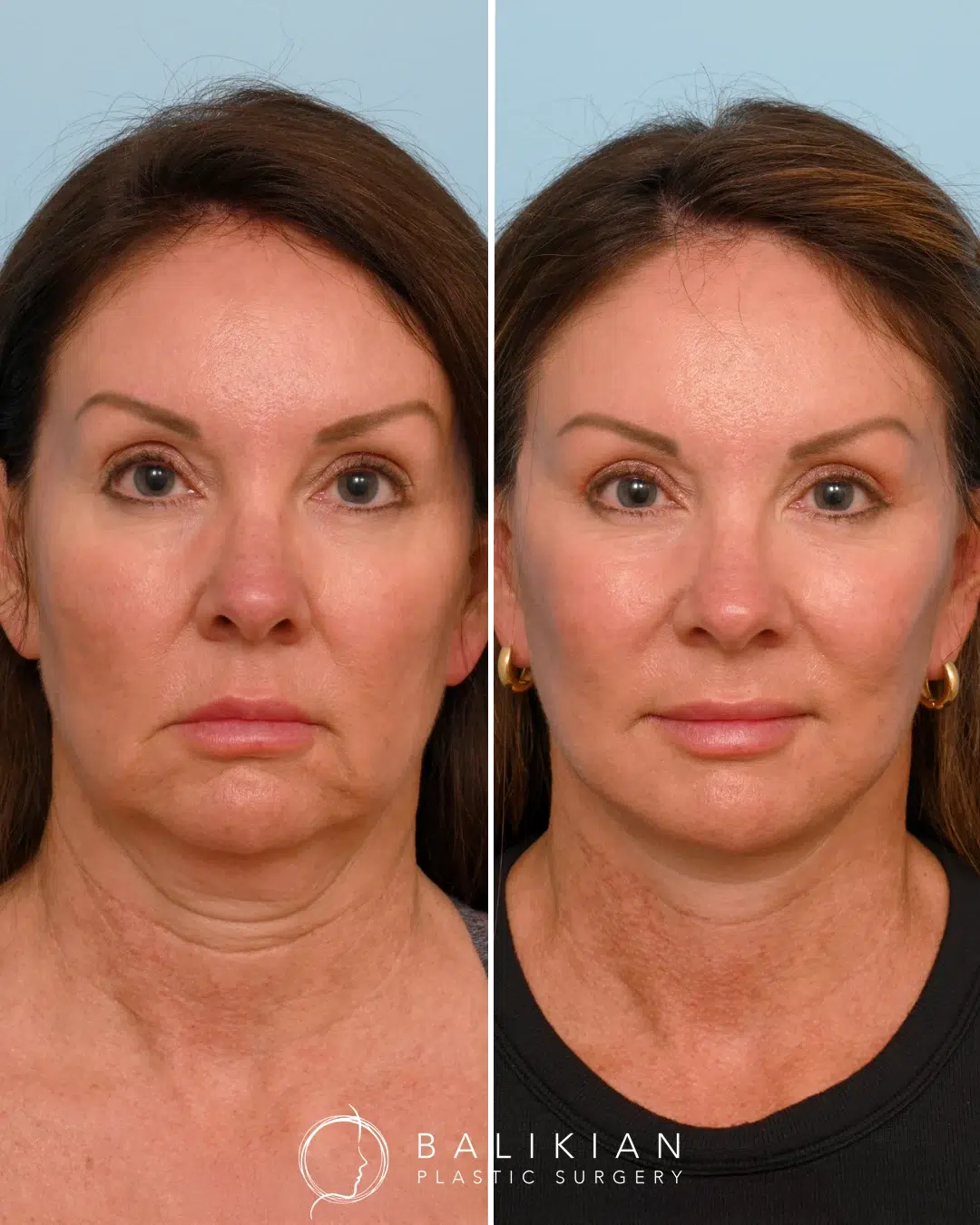Front view before and after facelift showing youthful neck contour and natural definition.