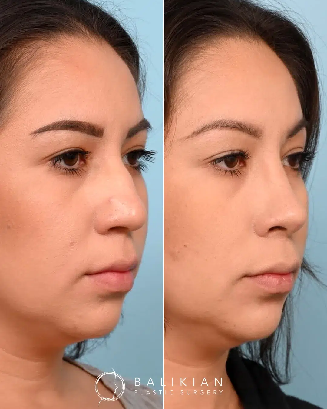 Before and after rhinoplasty, oblique view, dorsal hump reduction with subtle tip definition.