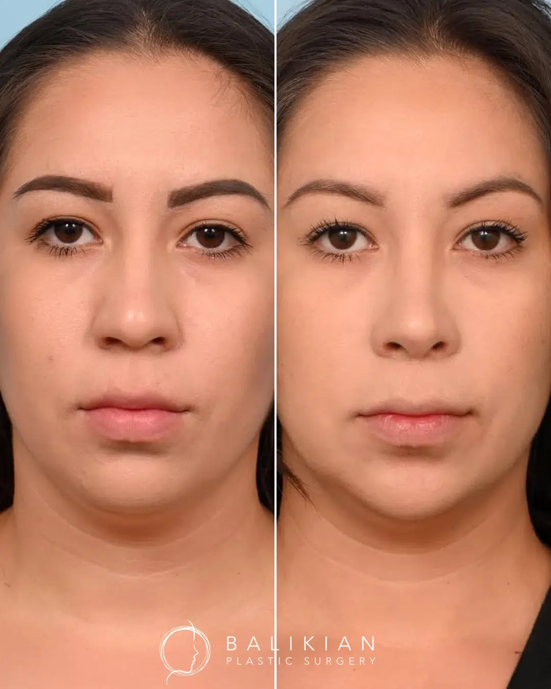 Before and after rhinoplasty, front view, straighter bridge and refined tip with improved symmetry.