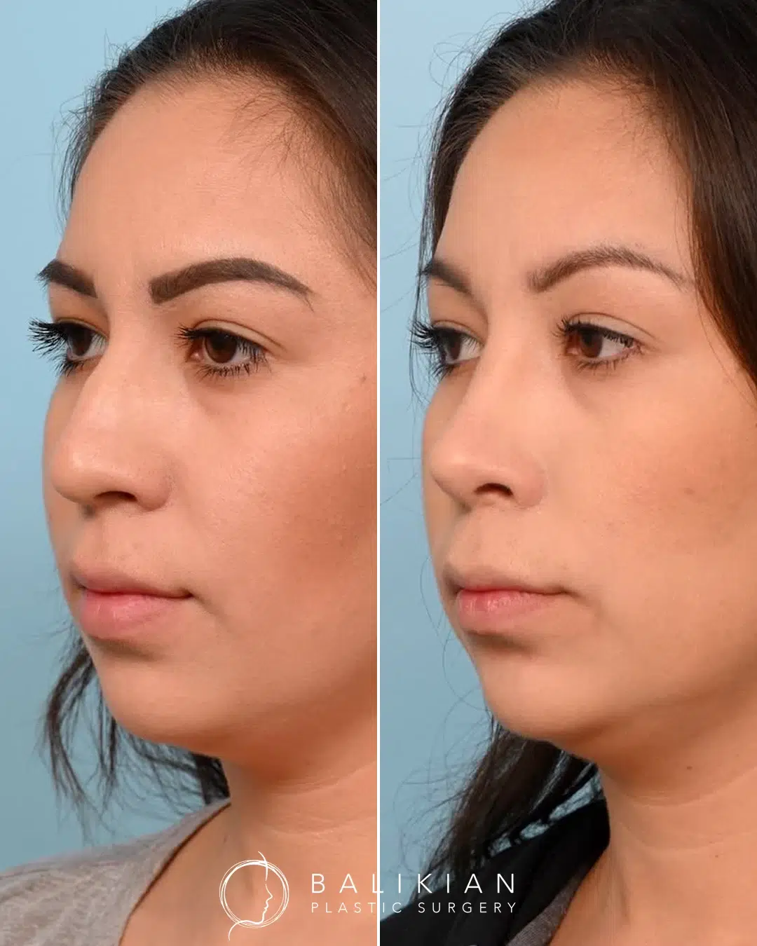 Before and after rhinoplasty, oblique view, smoother bridge and more balanced nostrils.