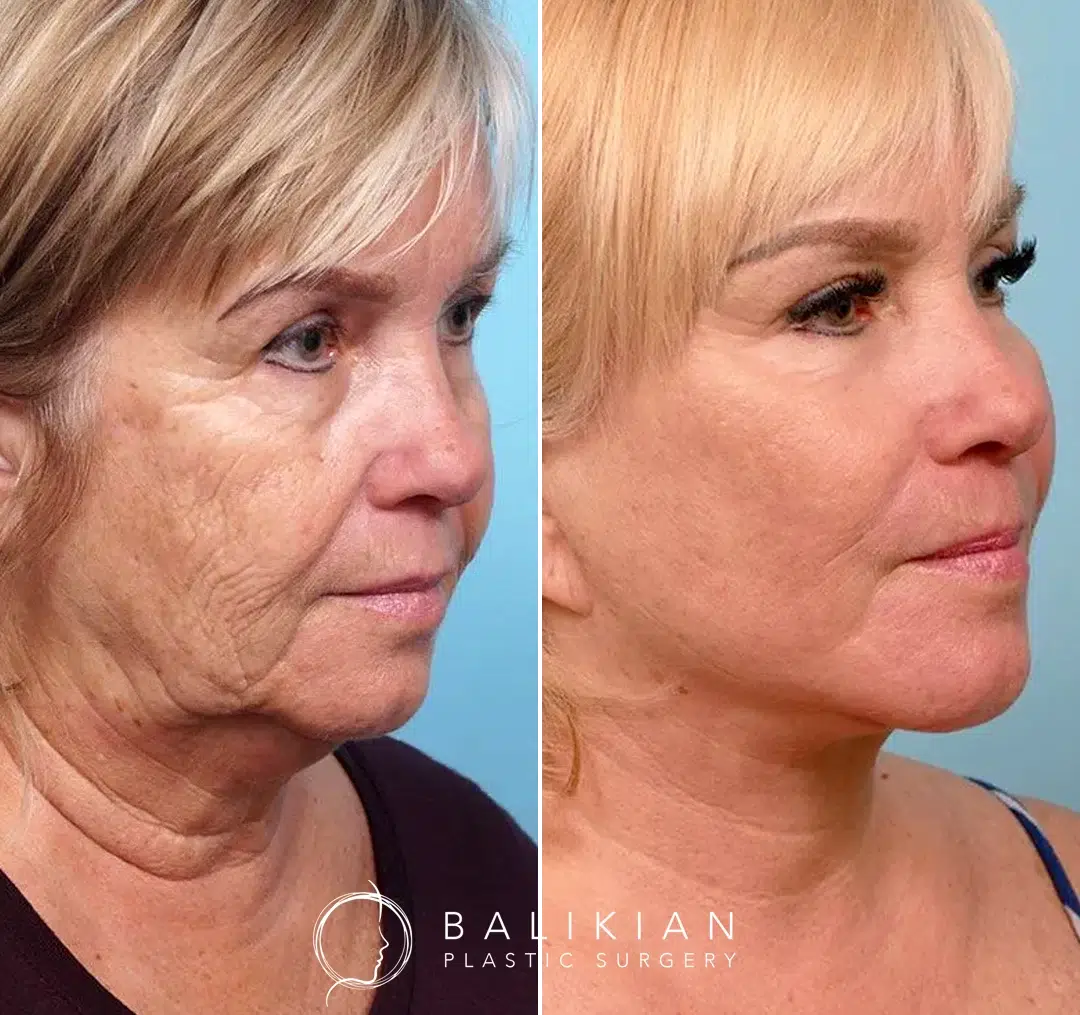 Angled before-and-after photos of a woman after facelift surgery, showing smoother skin, tightened jawline, and reduced facial wrinkles.