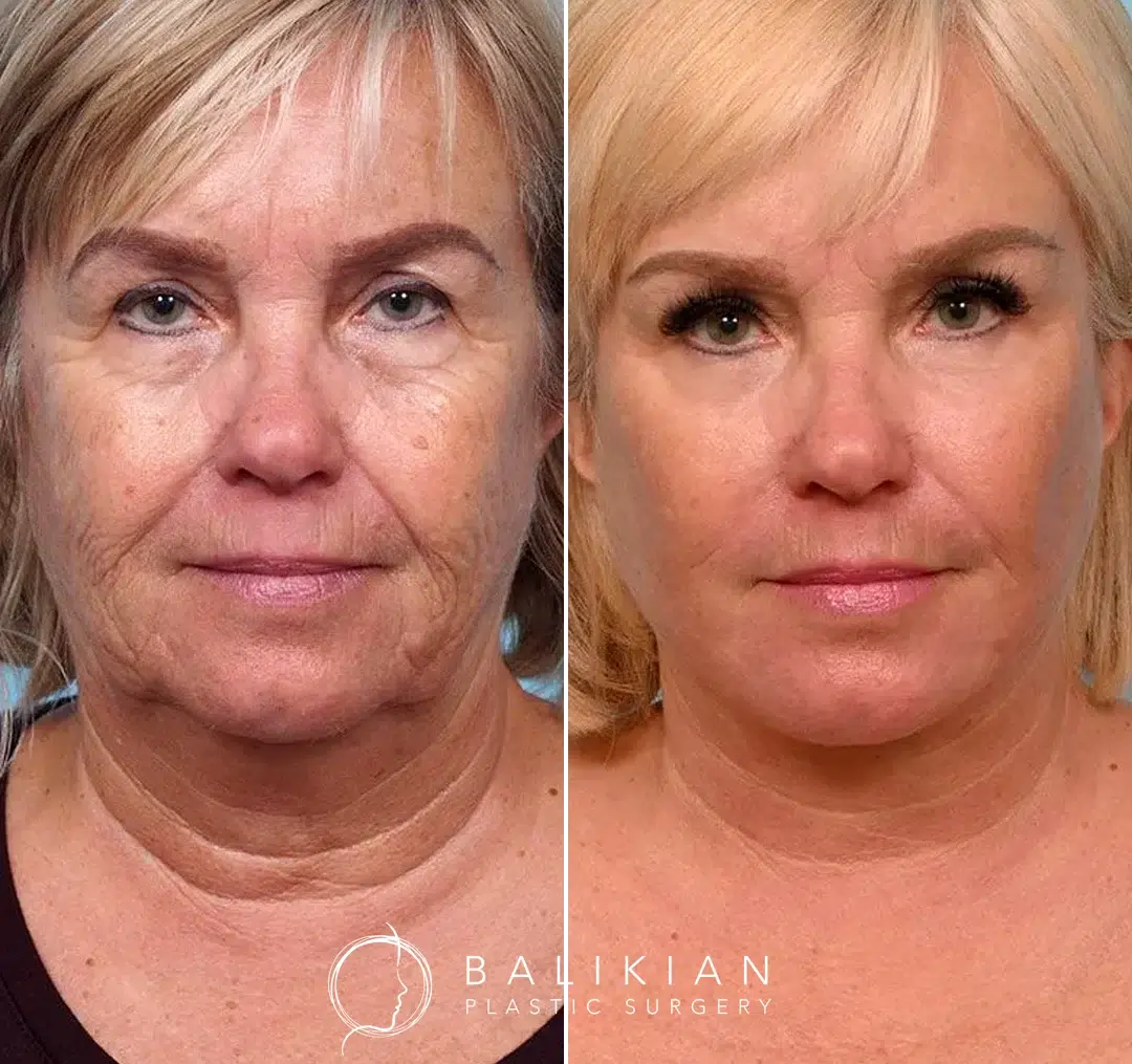 Front-facing before-and-after photos of a woman after facelift surgery, highlighting lifted cheeks, reduced sagging, and a smoother, rejuvenated facial appearance.