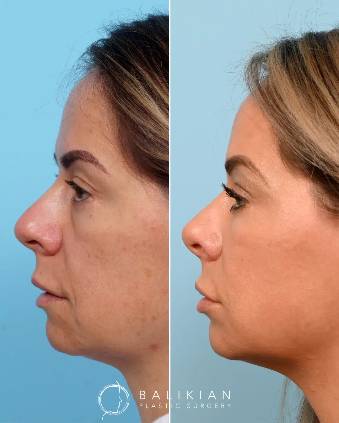 Left profile before and after revision rhinoplasty on a woman, with a straighter bridge and elevated nasal tip.