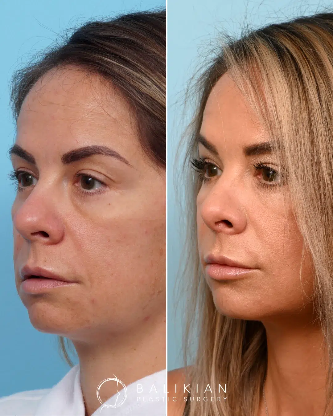 Oblique view before and after revision rhinoplasty on a woman, showing a smoother nasal bridge and refined tip.