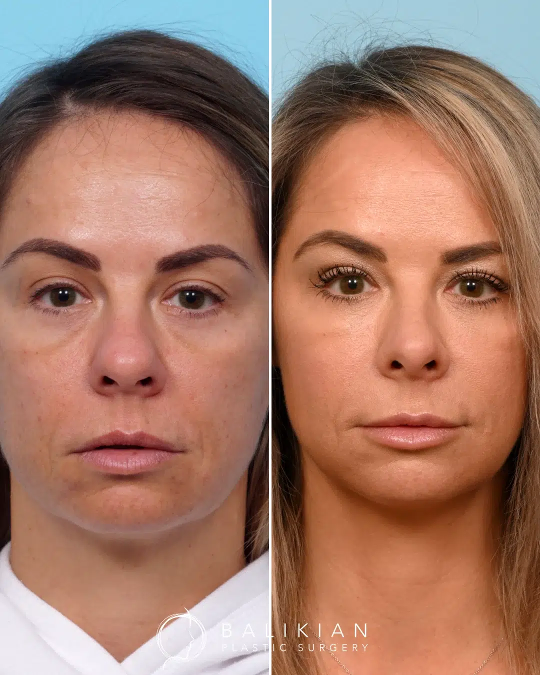 Frontal view before and after revision rhinoplasty on a woman, with a more defined nasal tip and symmetrical nostrils.