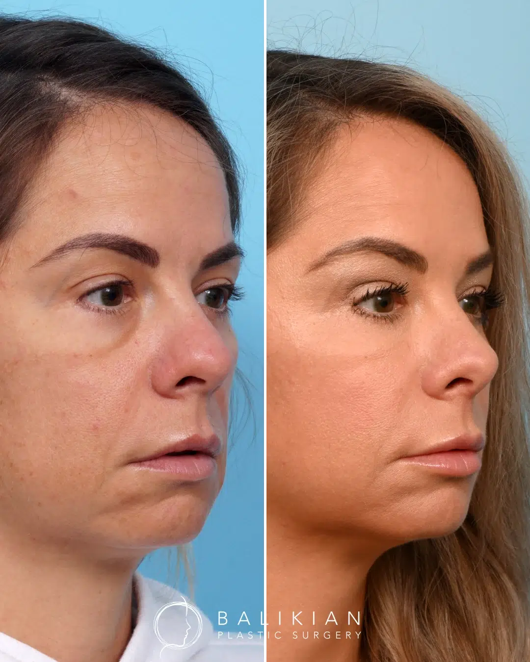 Opposite oblique view before and after revision rhinoplasty on a woman, showing improved nasal contour and balanced proportions.