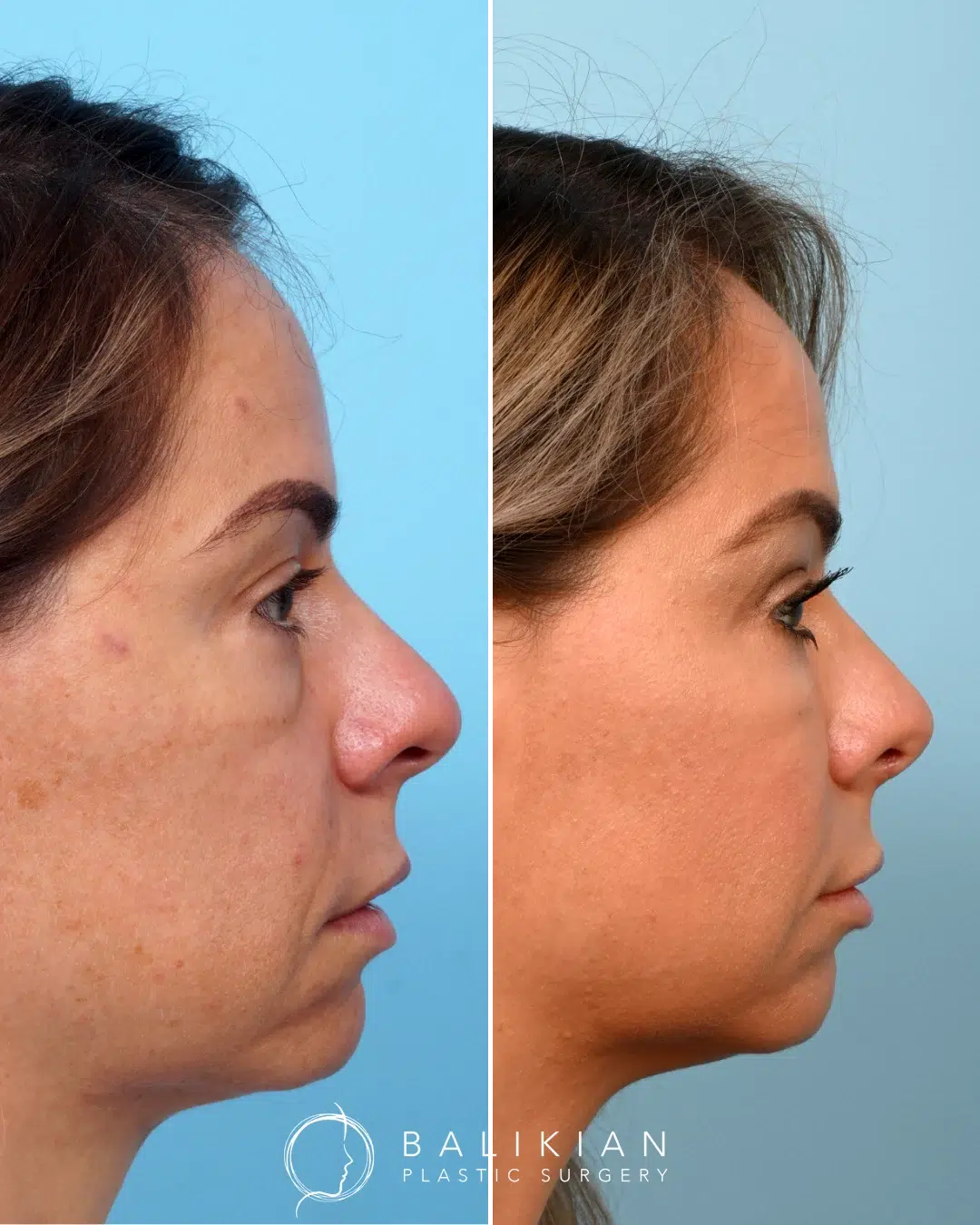 Left profile before and after revision rhinoplasty on a woman, showing a reduced dorsal hump and a refined nasal tip.