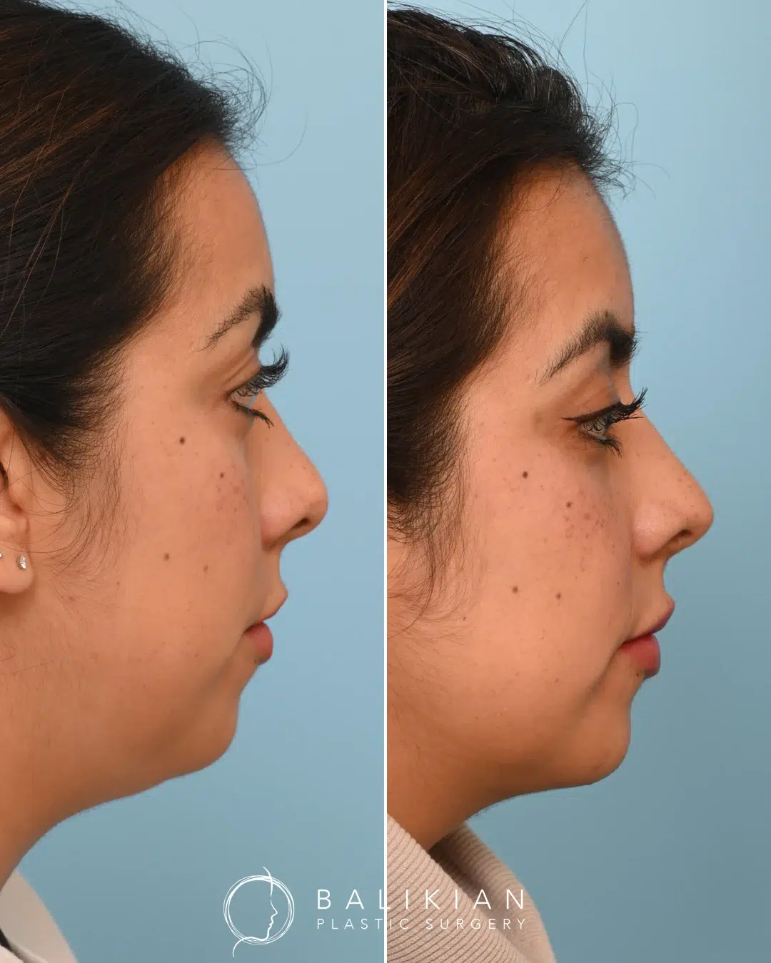 Before and after revision rhinoplasty, side view. Dorsal hump removed, tip refined, balanced profile.