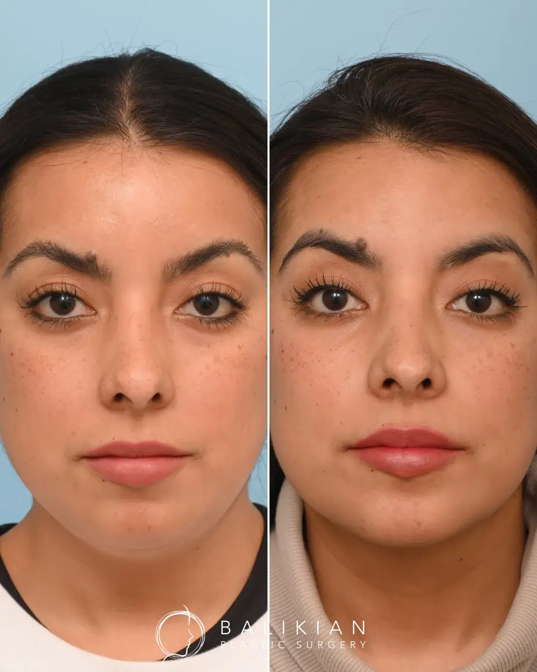 Before and after revision rhinoplasty, front close-up. Narrower tip, more even nostrils, refined appearance.